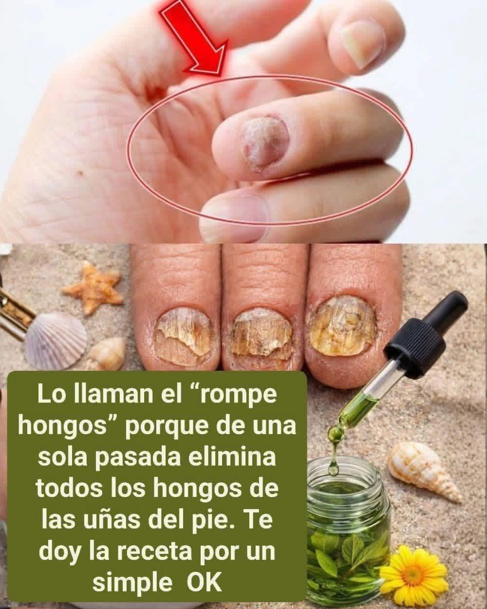 Lo llaman el “rompe hongos” porque de una sola pasada elimina todos los hongos de las uñas del pie. Te doy la receta por un simple OK
