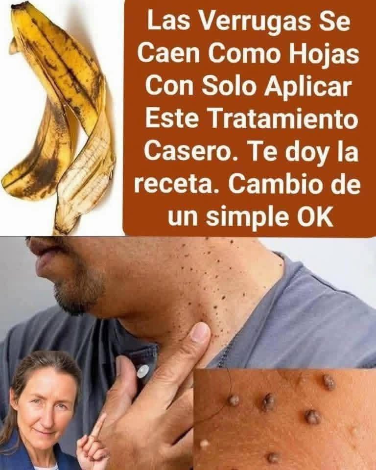 Dile Adiós a las Verrugas