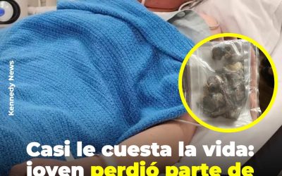 Casi le cuesta la vida: joven perdió parte de un pulmón por vapear sin descanso desde los 14 años
