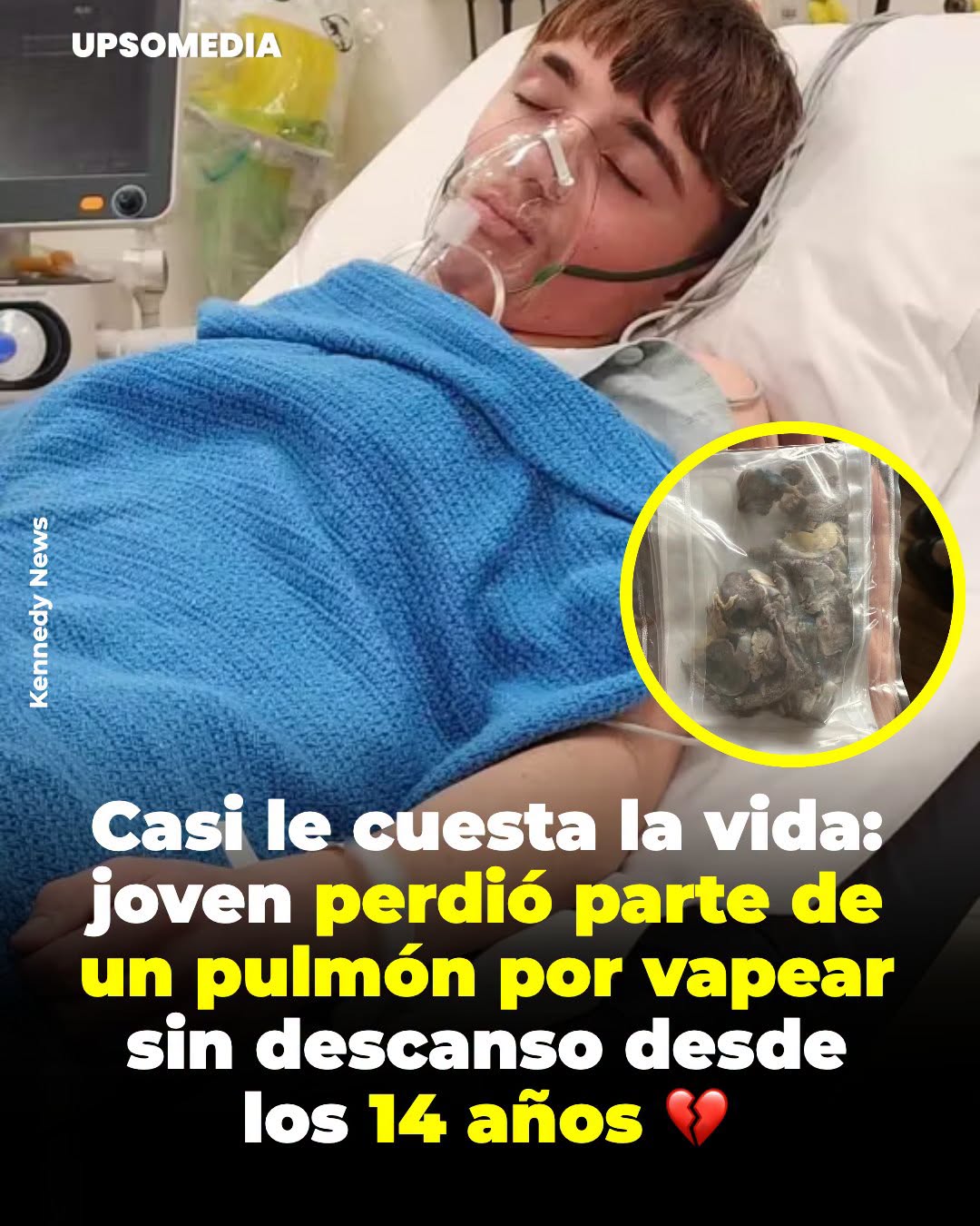 Casi le cuesta la vida: joven perdió parte de un pulmón por vapear sin descanso desde los 14 años